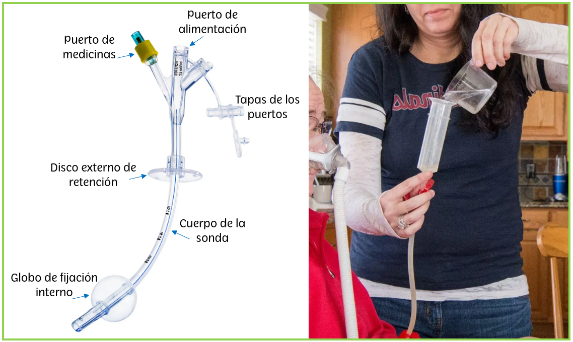 Gastrostomía: el uso de sondas para alimentación – ELA PERÚ